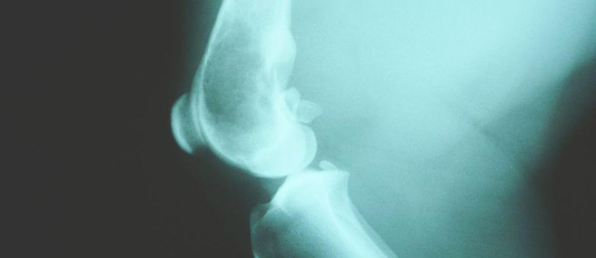 Osteosarcoom (Botkanker) bij een Leonberger