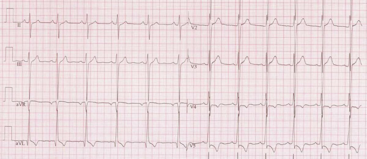 Aortastenose