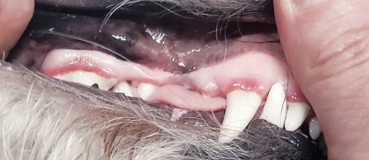 Gingivitis