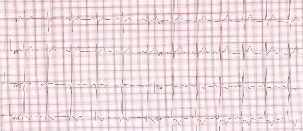 Aortastenose