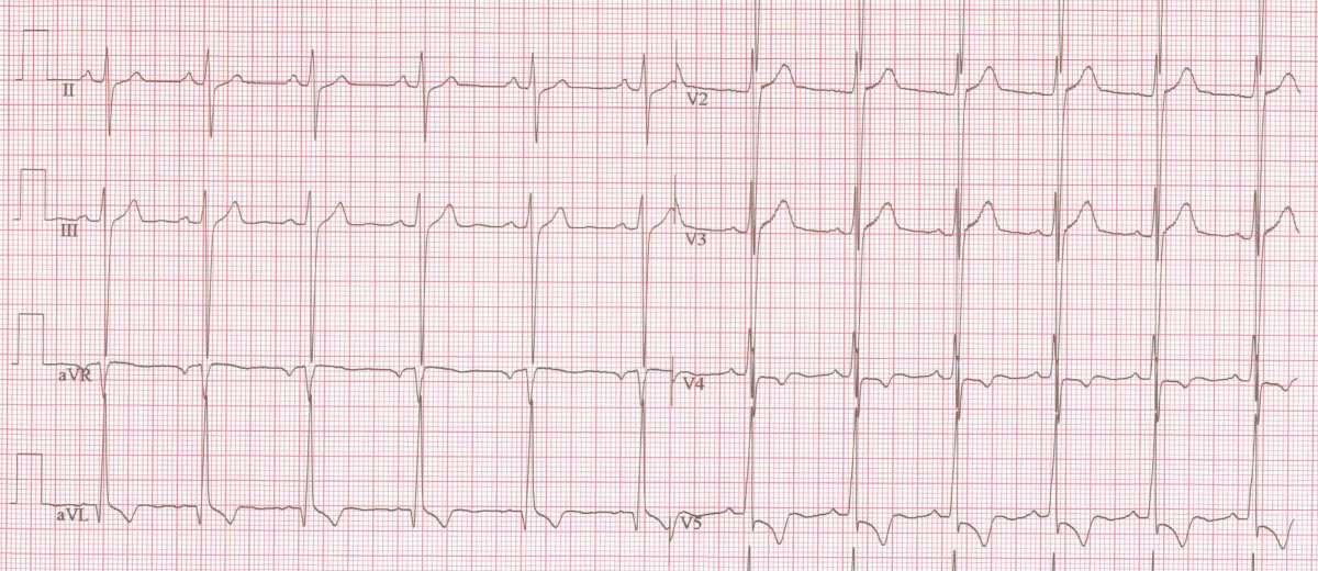 Aortastenose bij een Boxer