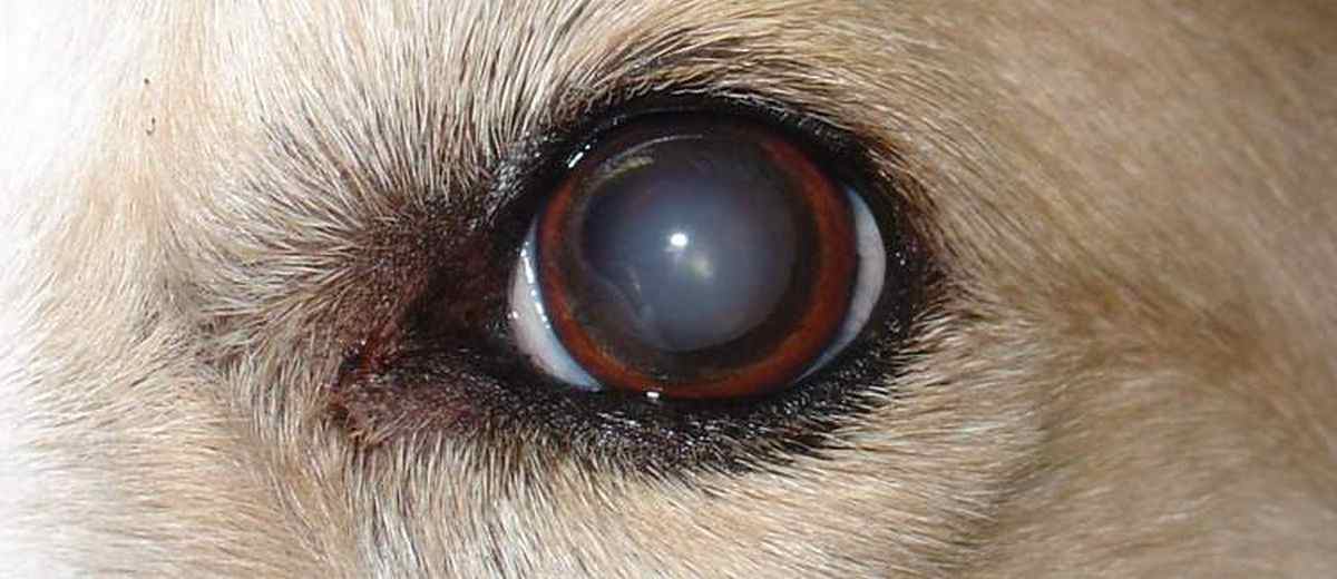 Cataract