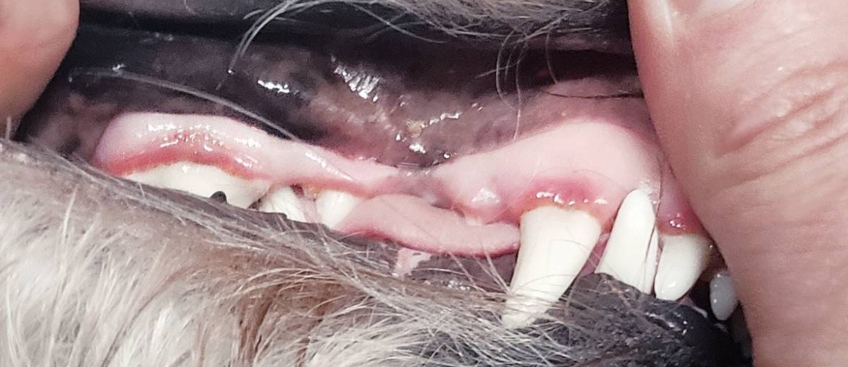 Gingivitis