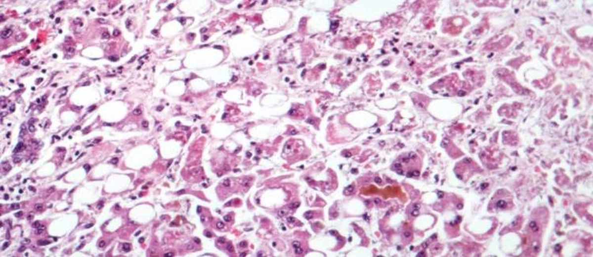Hepatitis