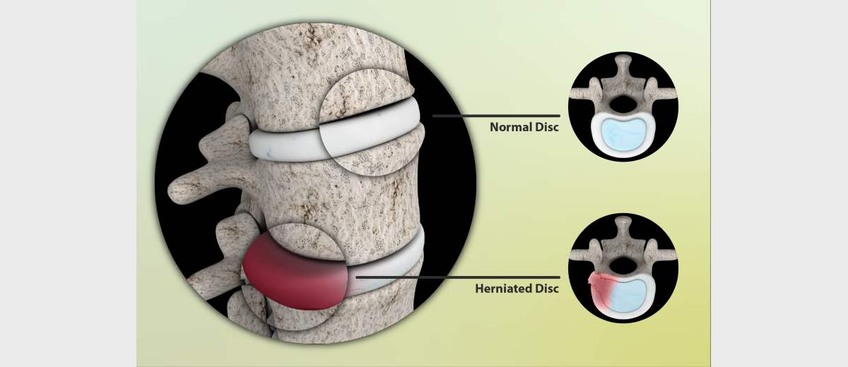 Hernia nuclei pulposi bij een Mopshond