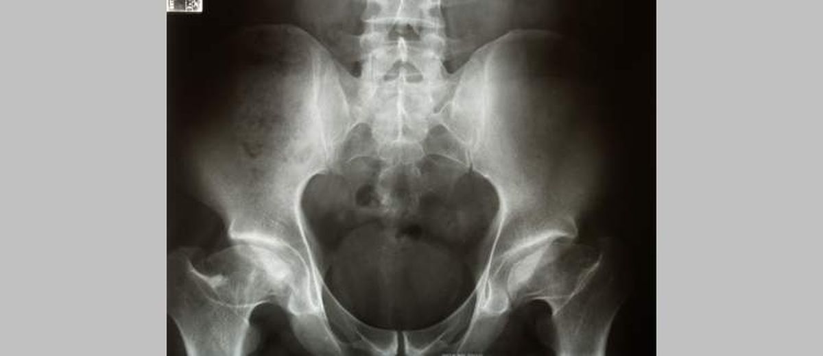 Legg Perthes Calvé