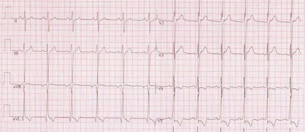Aortastenose