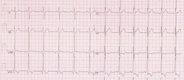 Aortastenose