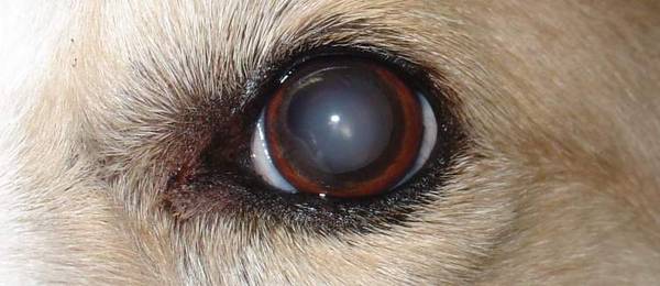 Cataract