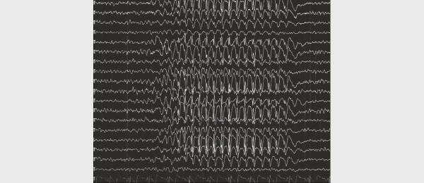 Epilepsie
