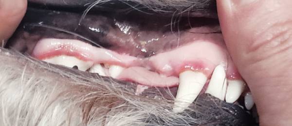 Gingivitis