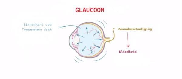 Glaucoom, groene staar, verhoogde oogdruk