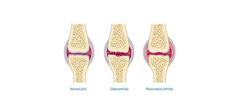 Immuungemedieerde artritis