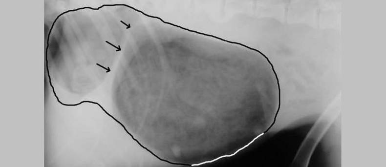 Maag-dilatatie-volvulus  (maagtorsie)